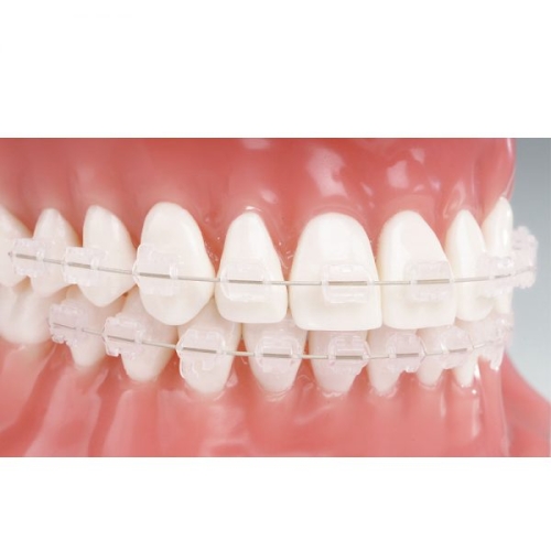 Mắc Cài Sứ Ortho Technology – Thẩm Mỹ Cao, Bền Chắc, Giá Hợp Lý